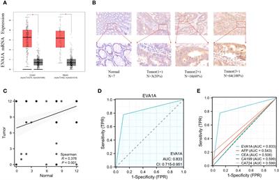 EVA1A, a novel and promising prognostic biomarker in colorectal cancer